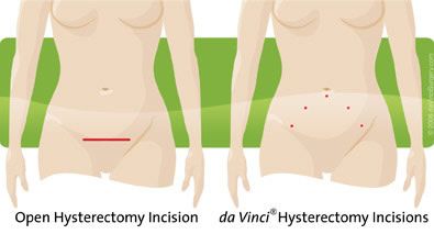 Illustration comparing the incision made in an open hysterectomy versus the incisions made in a da Vinci hysterectomy