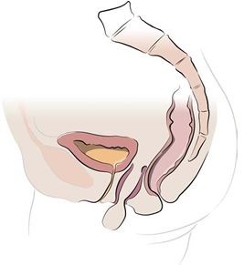 Figure 1. Diagram of a vaginal vault prolapse (description to follow)