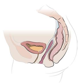 Figure 2. Diagram of a vaginal vault prolapse (description to follow)